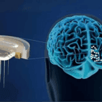 სამედიცინო Brain Implants ჩიპი, რომელიც თავსდება ადამიანის თავის ქალაში