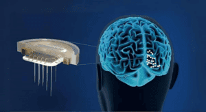 Brain Implants: ტვინის 1 საიდუმლო ჩიპი კიბოს წინააღმდეგ, Boom!